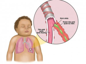 piek zuigelingen tussen 2 en 6 maanden, bij 3 jr vrijwel alle kinderen doorgemaakt. oudere kinderen/volwassenen BLWI, jongere kinderen uitbreiding naar OLWI: bronchiolitis.