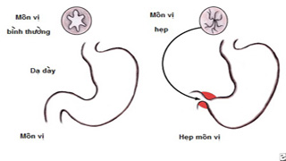 Bệnh hẹp phì đại môn vị